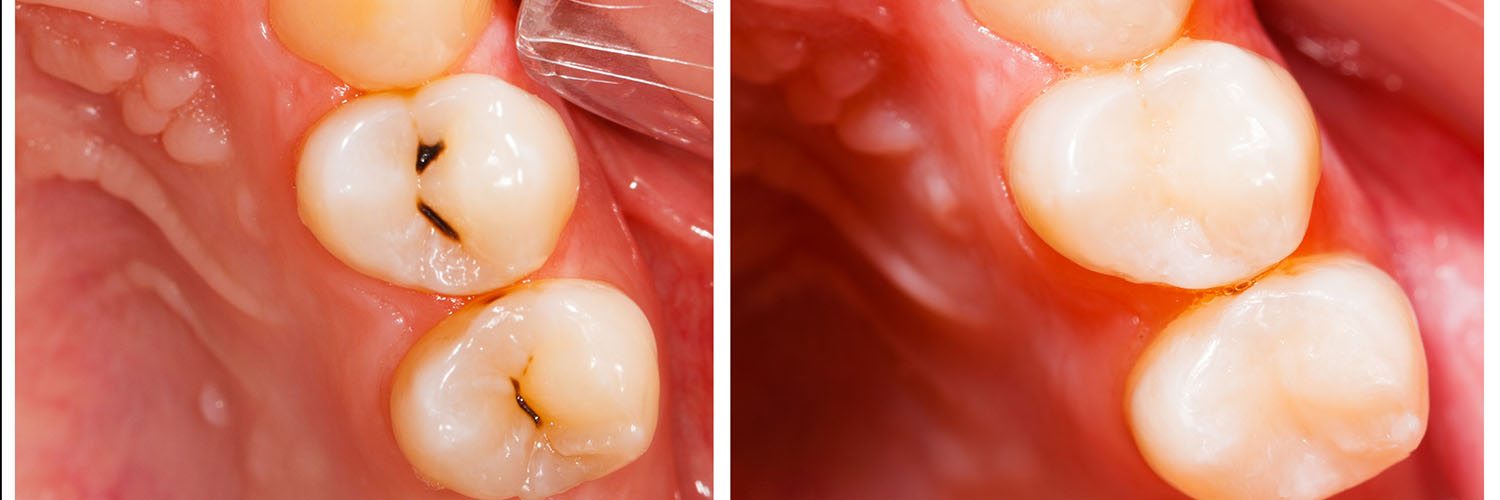 The image shows a close-up view of a person s mouth with teeth showing signs of decay, specifically cavities, and a tongue visible at the bottom.