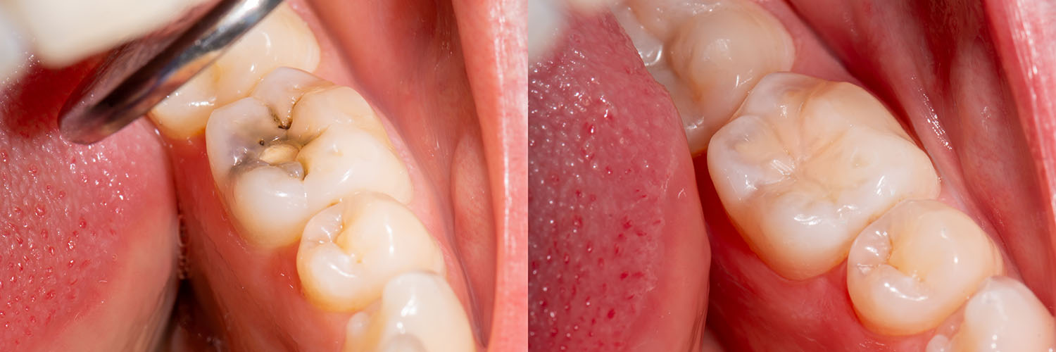 The image shows a close-up view of an open mouth with teeth, gums, and tongue visible, displaying a dental implantation process with a pinkish-red surgical area around the implant site.